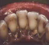 EARLY AND MODERATE PERIODONTITIS 1
