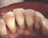 EARLY AND MODERATE PERIODONTITIS 2