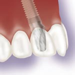 Replace a Single Tooth with an implant and crown