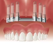 Support and Retain an Overdenture on a bar attached to several implants.